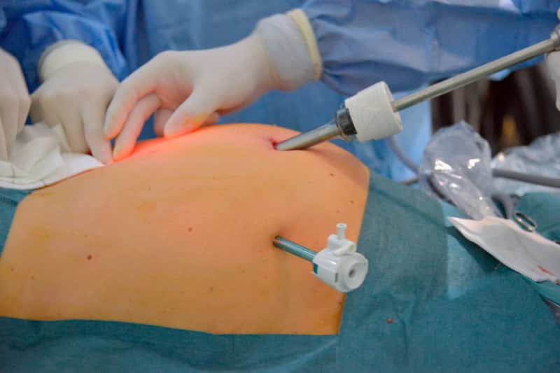 Cirugía de vesícula biliar extirpación laparoscópica