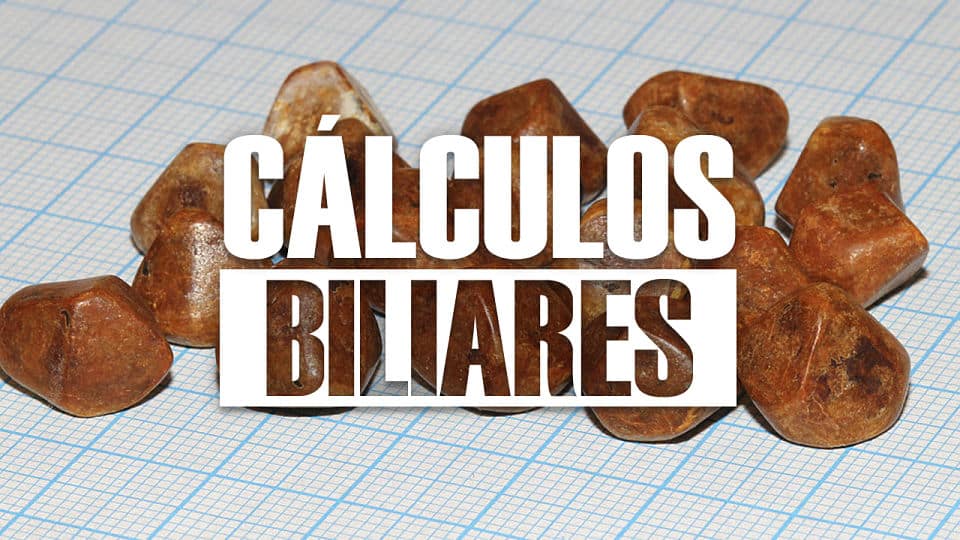 CALCULOS BILIARES